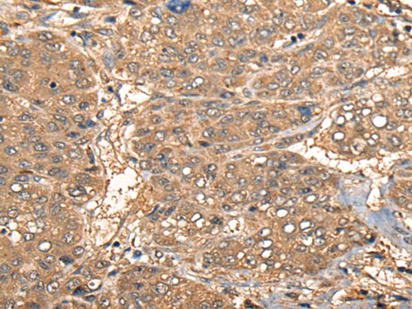 CCL27 Antibody - Immunohistochemistry of paraffin-embedded Human liver cancer tissue  using CCL27 Polyclonal Antibody at dilution of 1:55(×200)