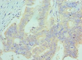 CCL28 / MEC Antibody - Immunohistochemistry of paraffin-embedded human colon cancer using antibody at 1:100 dilution.