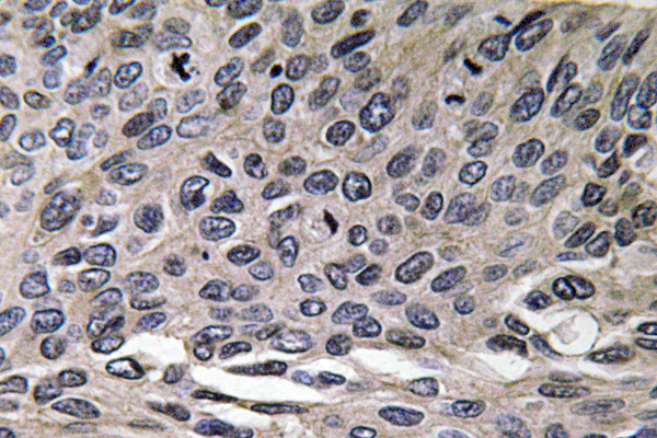 CCL3 / MIP-1-Alpha Antibody - IHC of MIP-1 (D75) pAb in paraffin-embedded human lung carcinoma tissue.