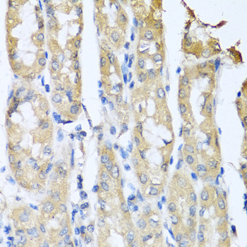 CCL3 / MIP-1-Alpha Antibody - Immunohistochemistry of paraffin-embedded human gastric cancer tissue.