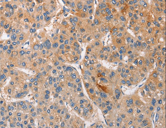 CCL4 / MIP-1 Beta Antibody - Immunohistochemistry of paraffin-embedded Human thyroid cancer using CCL4 Polyclonal Antibody at dilution of 1:40.
