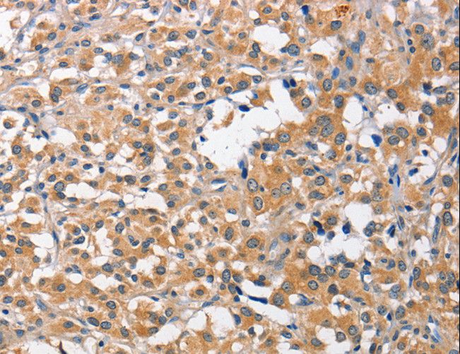 CCL4 / MIP-1 Beta Antibody - Immunohistochemistry of paraffin-embedded Human thyroid cancer using CCL4 Polyclonal Antibody at dilution of 1:40.