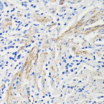 CCL4 / MIP-1 Beta Antibody - Immunohistochemistry of paraffin-embedded Human colon using CCL4 Polyclonal Antibody at dilution of 1:100 (40x lens).