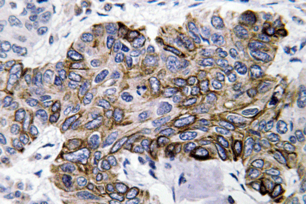 CCL5 / RANTES Antibody - Immunohistochemistry analysis of RANTES antibody in paraffin-embedded human lung carcinoma tissue.