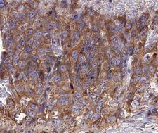 CCL5 / RANTES Antibody - IHC analysis of RANTES antibody in paraffin-embedded human lung carcinoma tissue