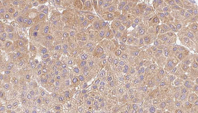 CCL5 / RANTES Antibody - 1:100 staining human Melanoma tissue by IHC-P. The sample was formaldehyde fixed and a heat mediated antigen retrieval step in citrate buffer was performed. The sample was then blocked and incubated with the antibody for 1.5 hours at 22°C. An HRP conjugated goat anti-rabbit antibody was used as the secondary.