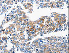 Ccl6 Antibody - Immunohistochemistry of paraffin-embedded Human lung cancer using CCL6 Polyclonal Antibody at dilution of 1:50.