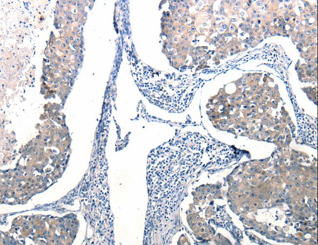 Ccl6 Antibody - Immunohistochemistry of paraffin-embedded Human breast cancer using Ccl6 Polyclonal Antibody at dilution of 1:50.