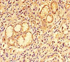 CCL8 / MCP2 Antibody - Immunohistochemistry of paraffin-embedded human gastric cancer using CCL8 Antibody at dilution of 1:100