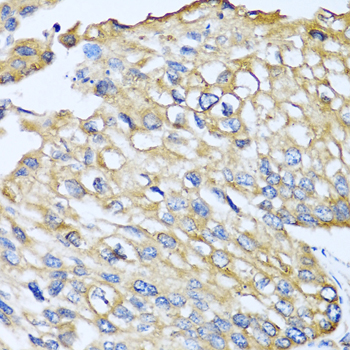 CCL8 / MCP2 Antibody - Immunohistochemistry of paraffin-embedded human prostate cancer tissue.