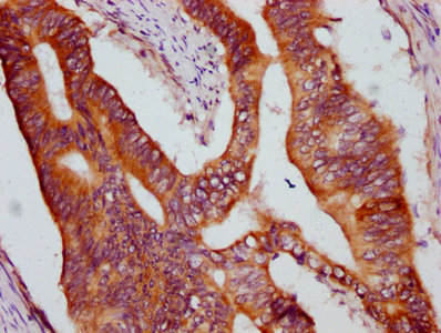 CCM1 / KRIT1 Antibody - Immunohistochemistry Dilution at 1:600 and staining in paraffin-embedded human colon cancer performed on a Leica BondTM system. After dewaxing and hydration, antigen retrieval was mediated by high pressure in a citrate buffer (pH 6.0). Section was blocked with 10% normal Goat serum 30min at RT. Then primary antibody (1% BSA) was incubated at 4°C overnight. The primary is detected by a biotinylated Secondary antibody and visualized using an HRP conjugated SP system.