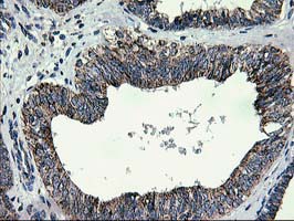 CCM2 / Malcavernin Antibody - IHC of paraffin-embedded Adenocarcinoma of Human endometrium tissue using anti-CCM2 mouse monoclonal antibody. (Heat-induced epitope retrieval by 10mM citric buffer, pH6.0, 100C for 10min).
