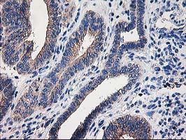 CCM2 / Malcavernin Antibody - IHC of paraffin-embedded Adenocarcinoma of Human endometrium tissue using anti-CCM2 mouse monoclonal antibody. (Heat-induced epitope retrieval by 10mM citric buffer, pH6.0, 100C for 10min).