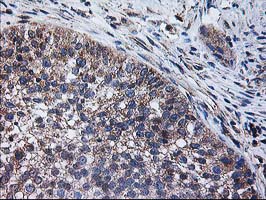 CCM2 / Malcavernin Antibody - IHC of paraffin-embedded Carcinoma of Human bladder tissue using anti-CCM2 mouse monoclonal antibody. (Heat-induced epitope retrieval by 10mM citric buffer, pH6.0, 100C for 10min).