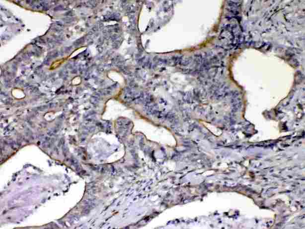 CCN3 / NOV Antibody - IHC analysis of NOV/CCN3 using anti-NOV/CCN3 antibody. NOV/CCN3 was detected in paraffin-embedded section of human intestinal cancer tissue. Heat mediated antigen retrieval was performed in citrate buffer (pH6, epitope retrieval solution) for 20 mins. The tissue section was blocked with 10% goat serum. The tissue section was then incubated with 1µg/ml rabbit anti-NOV/CCN3 Antibody overnight at 4°C. Biotinylated goat anti-rabbit IgG was used as secondary antibody and incubated for 30 minutes at 37°C. The tissue section was developed using Strepavidin-Biotin-Complex (SABC) with DAB as the chromogen.