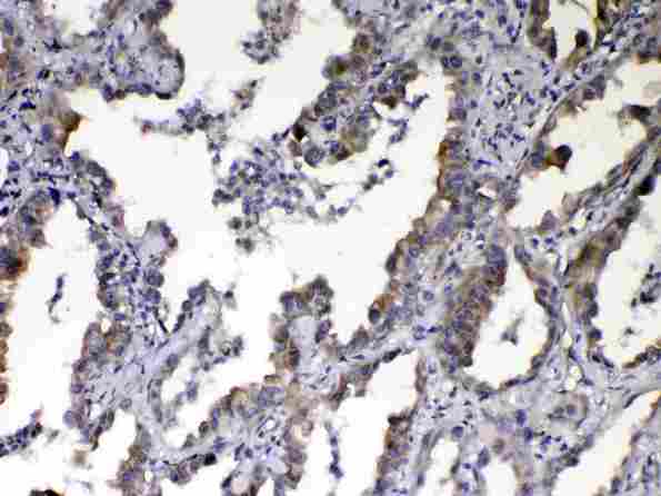 CCN3 / NOV Antibody - IHC analysis of NOV/CCN3 using anti-NOV/CCN3 antibody. NOV/CCN3 was detected in paraffin-embedded section of human lung cancer tissue. Heat mediated antigen retrieval was performed in citrate buffer (pH6, epitope retrieval solution) for 20 mins. The tissue section was blocked with 10% goat serum. The tissue section was then incubated with 1µg/ml rabbit anti-NOV/CCN3 Antibody overnight at 4°C. Biotinylated goat anti-rabbit IgG was used as secondary antibody and incubated for 30 minutes at 37°C. The tissue section was developed using Strepavidin-Biotin-Complex (SABC) with DAB as the chromogen.