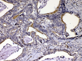 CCN3 / NOV Antibody - IHC testing of FFPE human intestinal cancer tissue with CCN3 antibody at 1ug/ml. Required HIER: steam section in pH6 citrate buffer for 20 min and allow to cool prior to testing.