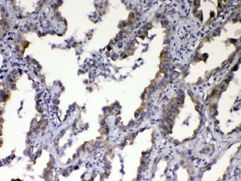 CCN3 / NOV Antibody - IHC testing of FFPE human lung cancer tissue with CCN3 antibody at 1ug/ml. Required HIER: steam section in pH6 citrate buffer for 20 min and allow to cool prior to testing.