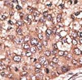 CCN4 / WISP1 Antibody - Formalin-fixed and paraffin-embedded human cancer tissue reacted with the primary antibody, which was peroxidase-conjugated to the secondary antibody, followed by DAB staining. This data demonstrates the use of this antibody for immunohistochemistry; clinical relevance has not been evaluated. BC = breast carcinoma; HC = hepatocarcinoma.