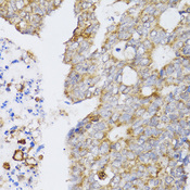 CCN5 Antibody - Immunohistochemistry of paraffin-embedded human colon carcinoma tissue.