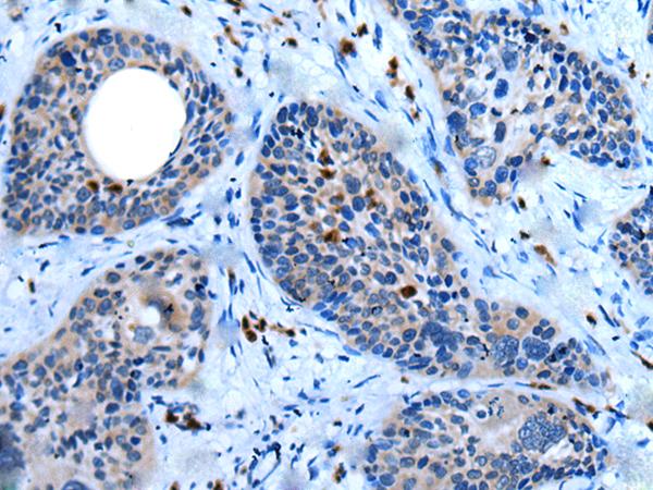 CCN5 Antibody - Immunohistochemistry of paraffin-embedded Human cervical cancer tissue  using WISP2 Polyclonal Antibody at dilution of 1:45(×200)