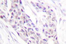 CCNA1 / Cyclin A1 Antibody - IHC of Cyclin A1 (R436) pAb in paraffin-embedded human breast carcinoma tissue.