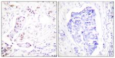 CCNA1 / Cyclin A1 Antibody - Peptide - + Immunohistochemical analysis of paraffin-embedded human breast carcinoma tissue using Cyclin A1 antibody.