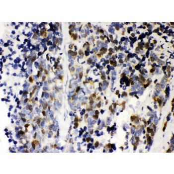 CCNA2 / Cyclin A2 Antibody - Cyclin A2 antibody IHC-paraffin. IHC(P): Human Lung Cancer Tissue.