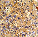 CCNA2 / Cyclin A2 Antibody - Formalin-fixed and paraffin-embedded human hepatocarcinoma with Cyclin A (CCNA2) Antibody , which was peroxidase-conjugated to the secondary antibody, followed by DAB staining. This data demonstrates the use of this antibody for immunohistochemistry; clinical relevance has not been evaluated.