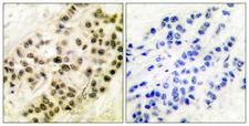 CCNB1 / Cyclin B1 Antibody - Immunohistochemistry analysis of paraffin-embedded human breast carcinoma tissue, using Cyclin B1 Antibody. The picture on the right is blocked with the synthesized peptide.