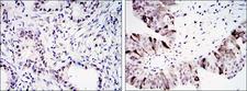 CCNB1 / Cyclin B1 Antibody - IHC of paraffin-embedded lung cancer (left) and ovary tumor tissues (right) using CCNB1 mouse monoclonal antibody with DAB staining.