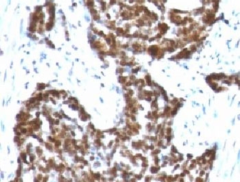 CCNB1 / Cyclin B1 Antibody - IHC testing of FFPE human ovarian carcinoma with Cyclin B1 antibody (clone BCLB1-1).  This image was taken for the unmodified form of this product. Other forms have not been tested.