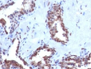CCNB1 / Cyclin B1 Antibody - IHC testing of FFPE human prostate carcinoma with Cyclin B1 antibody (clone BCLB1-1).  This image was taken for the unmodified form of this product. Other forms have not been tested.