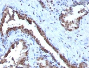 CCNB1 / Cyclin B1 Antibody - Formalin-fixed, paraffin-embedded human prostate carcinoma stained with Cyclin B1 antibody.  This image was taken for the unmodified form of this product. Other forms have not been tested.