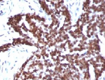 CCNB1 / Cyclin B1 Antibody - Formalin-fixed, paraffin-embedded human ovarian carcinoma stained with Cyclin B1 antibody.  This image was taken for the unmodified form of this product. Other forms have not been tested.