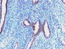 CCNB1 / Cyclin B1 Antibody - Formalin-fixed, paraffin-embedded human endometrial carcinoma stained with Cyclin B1 antibody (CCNB1/1098).  This image was taken for the unmodified form of this product. Other forms have not been tested.