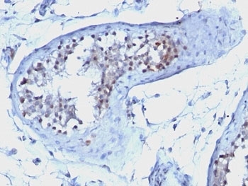 CCNB1 / Cyclin B1 Antibody - Formalin-fixed, paraffin-embedded human testicular carcinoma stained with Cyclin B1 antibody.  This image was taken for the unmodified form of this product. Other forms have not been tested.