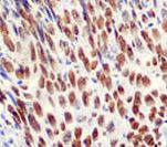 CCNB1 / Cyclin B1 Antibody - IHC of Cyclin B1 on FFPE Cervical Cancer tissue Intended Use For In Vitro Diagnostic Use.