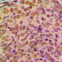 CCNB1 / Cyclin B1 Antibody - Immunohistochemical analysis of Cyclin B1 staining in human breast cancer formalin fixed paraffin embedded tissue section. The section was pre-treated using heat mediated antigen retrieval with sodium citrate buffer (pH 6.0). The section was then incubated with the antibody at room temperature and detected using an HRP conjugated compact polymer system. DAB was used as the chromogen. The section was then counterstained with hematoxylin and mounted with DPX.
