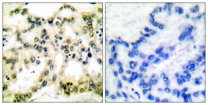 CCNB1 / Cyclin B1 Antibody - Immunohistochemistry analysis of paraffin-embedded human lung carcinoma, using Cyclin B1 (Phospho-Ser126) Antibody. The picture on the right is blocked with the phospho peptide.
