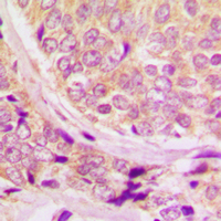 CCNB1 / Cyclin B1 Antibody - Immunohistochemical analysis of Cyclin B1 (pS147) staining in human breast cancer formalin fixed paraffin embedded tissue section. The section was pre-treated using heat mediated antigen retrieval with sodium citrate buffer (pH 6.0). The section was then incubated with the antibody at room temperature and detected using an HRP conjugated compact polymer system. DAB was used as the chromogen. The section was then counterstained with hematoxylin and mounted with DPX.