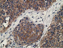 CCNB1IP1 Antibody - IHC of paraffin-embedded Carcinoma of Human bladder tissue using anti-CCNB1IP1 mouse monoclonal antibody. (Heat-induced epitope retrieval by 10mM citric buffer, pH6.0, 100C for 10min).