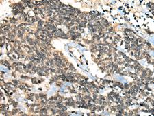 CCNB1IP1 Antibody - Immunohistochemistry of paraffin-embedded Human lung cancer tissue  using CCNB1IP1 Polyclonal Antibody at dilution of 1:30(×200)