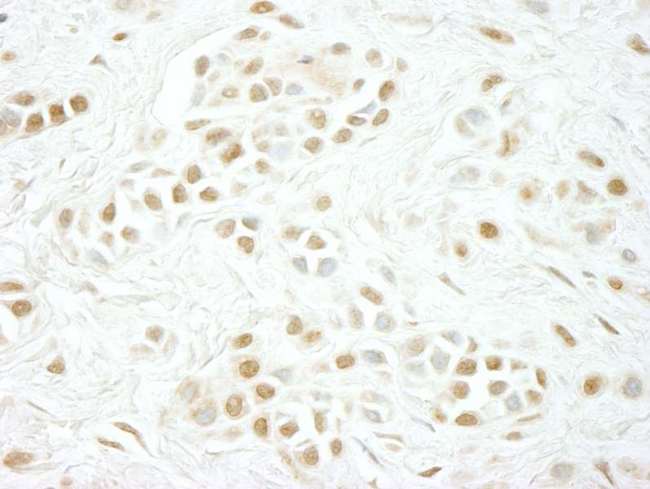 CCNC / Cyclin C Antibody - Detection of Human Cyclin C by Immunohistochemistry. Sample: FFPE section of human skin squamous cell carcinoma. Antibody: Affinity purified rabbit anti-Cyclin C used at a dilution of 1:100.