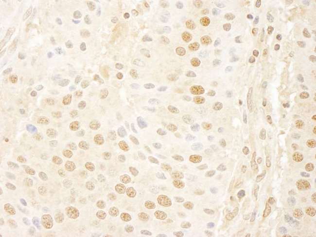 CCNC / Cyclin C Antibody - Detection of Human Cyclin C by Immunohistochemistry. Sample: FFPE section of human pancreatic islet cell tumor. Antibody: Affinity purified rabbit anti-Cyclin C used at a dilution of 1:100. Epitope Retrieval Buffer-High pH (IHC-101J) was substituted for Epitope Retrieval Buffer-Reduced pH.
