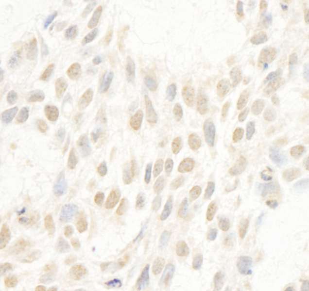 CCNC / Cyclin C Antibody - Detection of Human Cyclin C by Immunohistochemistry. Sample: FFPE section of human breast carcinoma. Antibody: Affinity purified rabbit anti-Cyclin C used at a dilution of1:1000 (1 ug/ml). Detection: DAB.