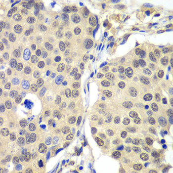 CCNC / Cyclin C Antibody - Immunohistochemistry of paraffin-embedded human lung cancer tissue.