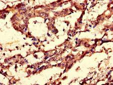 CCNC / Cyclin C Antibody - Immunohistochemistry of paraffin-embedded human gastric cancer using CCNC Antibody at dilution of 1:100
