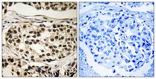 CCNC / Cyclin C Antibody - P-peptide - + Immunohistochemistry analysis of paraffin-embedded human breast carcinoma tissue using Cyclin C (Phospho-Ser275) antibody.