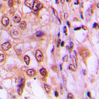 CCND1 / Cyclin D1 Antibody - Immunohistochemical analysis of Cyclin D1 (pT286) staining in human breast cancer formalin fixed paraffin embedded tissue section. The section was pre-treated using heat mediated antigen retrieval with sodium citrate buffer (pH 6.0). The section was then incubated with the antibody at room temperature and detected using an HRP-conjugated compact polymer system. DAB was used as the chromogen. The section was then counterstained with hematoxylin and mounted with DPX.